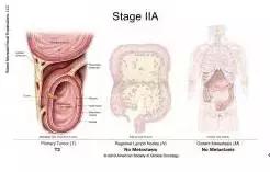 得了直肠癌怎么知道,你了解结直肠癌吗