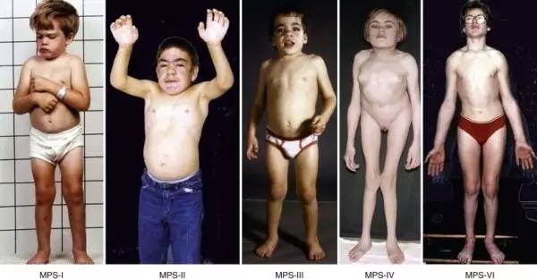 罕见病儿童时期发病,究竟罕见病孩子应该治疗还是放弃