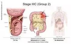 得了直肠癌怎么知道,你了解结直肠癌吗