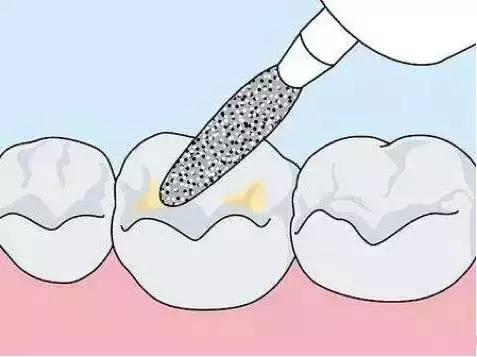 乳牙到底要不要根管治疗,儿童乳牙是全部要换的吗