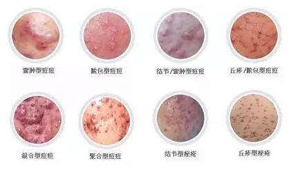 疮疡是什么病引起的,疮疗的后遗症怎么治疗