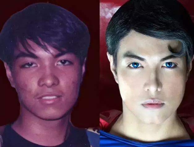 越来越多的男性整形,男士整容变帅案例