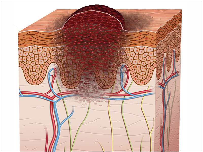 长在手指头的黑点是癌细胞吗,手指黑点癌症特征