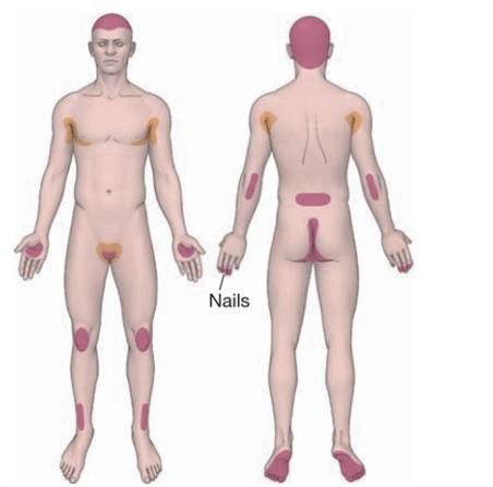 银屑病发病机制动画 (银屑病发病机制是什么)