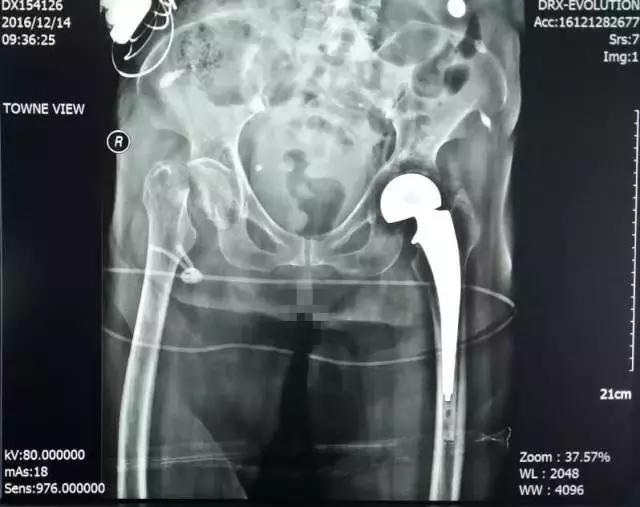 人生最后一次骨折保守治疗,髋部骨折又称人生最后一次骨折