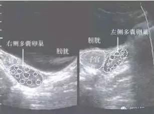 妇科内分泌紊乱之PCOS篇
