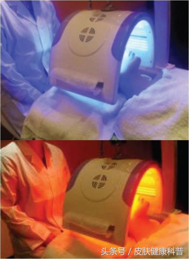 面部皮肤屏障受损要怎么修复,激素脸怎么修复皮肤屏障