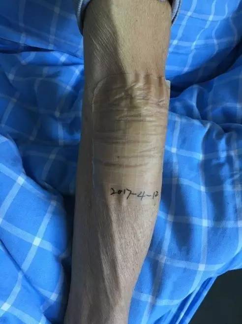 造影剂外渗如何处理,做cta时造影剂外渗怎么办