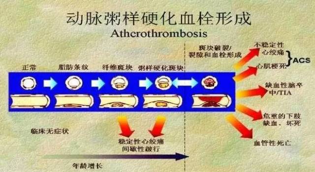 左侧股总动脉粥样斑块形成,吸烟造成动脉粥样斑块形成