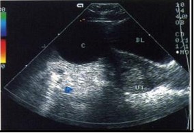 卵巢囊肿的b超描述,卵巢生理性囊肿的b超影像