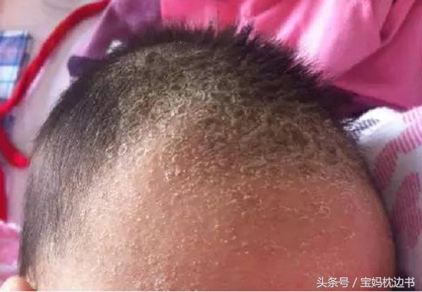 怎么判断是湿疹还是粟粒疹,宝宝湿疹丘疹