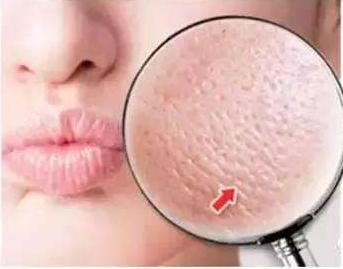 毛孔粗大怎么办用什么护肤品好,毛孔粗大怎样化妆才能遮住毛孔