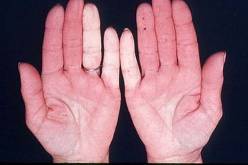 皮肤变硬的病,皮肤变硬就一定是硬皮病吗