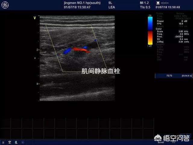骨折手术后有点隐隐的疼正常吗,骨折手术后下肢血栓怎么办