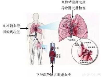 骨折手术后是麻木好还是疼好,骨折术后静脉血栓症状表现