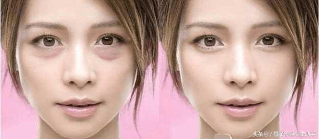 眼袋大的原因和去眼袋方法,眼袋重显老去眼袋的方法