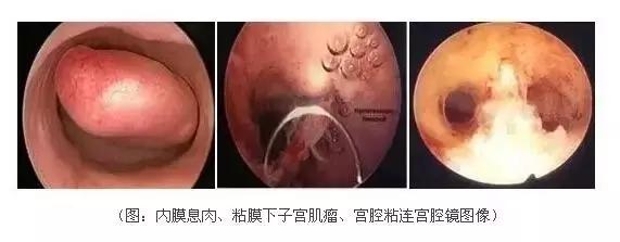 关于宫腔镜，准妈妈应该知晓的二三事