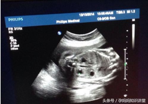 怎么看b超单判断胎儿怀孕,早孕b超图怎么看出胎儿性格