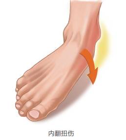 脚脖子扭伤没肿胀,脚脖子扭伤叫什么