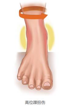 脚脖子扭伤没肿胀,脚脖子扭伤叫什么