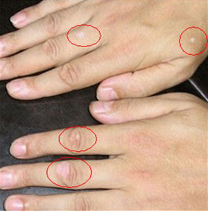 什么样是白癜风,什么症状可以确定是白癜风