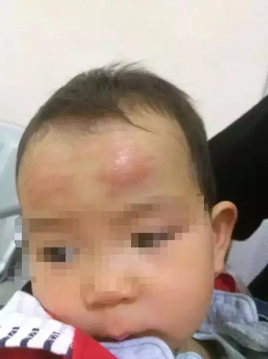 退热贴过敏发红起疹子怎么办,宝宝贴完退热贴额头起红斑怎么办