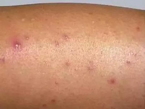 脱毛不小心刮掉一层皮怎么办,脱毛不小心刮伤补救