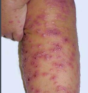 皮炎的几种常见类型介绍