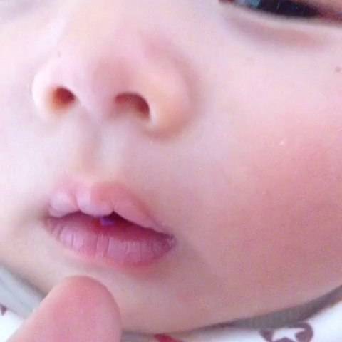 宝宝患上鹅口疮是怎么回事？妈妈正确的做法