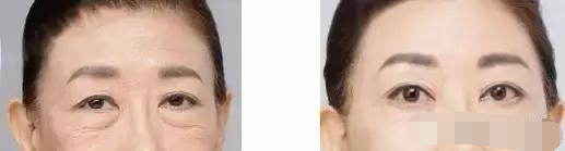 抢救假性眼纹、眼袋的黄金时间，错过你就老了