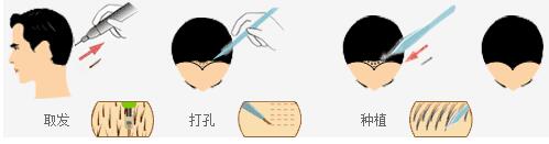 济南遗传性脱发植发效果如何,脂溢性脱发遗传性脱发植发有用吗