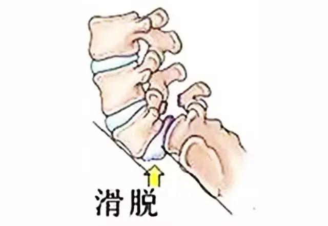 腰椎滑脱和腰椎间盘突出哪个严重,腰椎间盘突出滑脱手术要多少时间