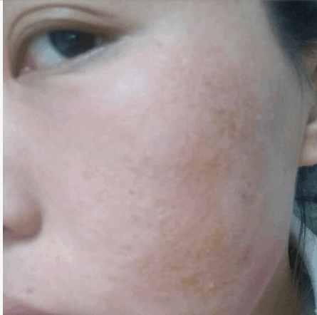 激素脸痒脱皮是在排毒吗,激素脸是怎么引起的有哪些症状