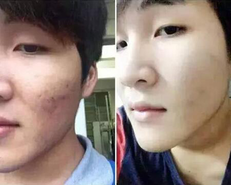 15岁的男生脸上长痘痘怎么调理,男生脸上长痘痘要怎么才能消除啊