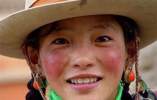 红血丝的形成诱因及解决方法,红血丝的症状与治疗