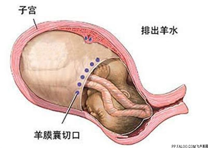 剖腹产挨几刀,剖腹产需要开几刀