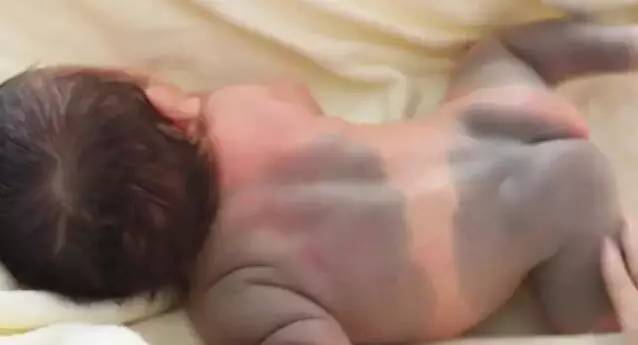 初生婴儿痣和胎记怎么区别,孩子长痣和胎记区别