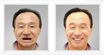 你知道缺牙的后果有多严重吗,你真的知道缺牙的危害