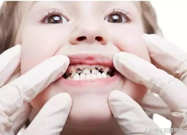 小孩子牙齿全部烂光,五岁男孩牙齿全烂了