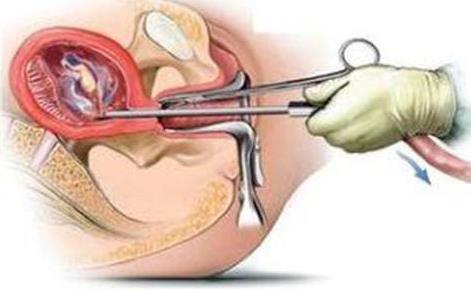 从来没有怀孕宫腔却有粘连,得了宫腔粘连就一定不孕了吗
