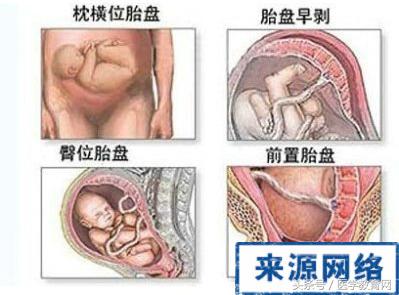剖腹产女性手术,女的剖腹产手术的全部流程