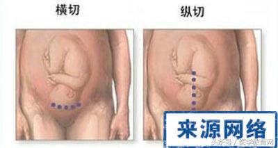 剖腹产女性手术,女的剖腹产手术的全部流程