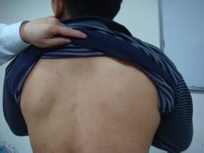 华夏讲述：白斑反复有原因？早早防范不复发？