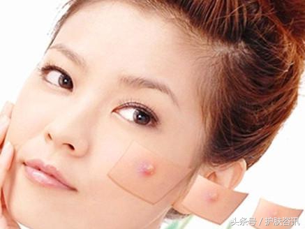 成年人脸上长痘痘什么原因,成年人长痘痘是缺乏营养吗