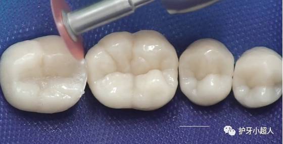 补牙全过程的五个步骤详解,补牙一般需要几步完成