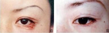 做眼袋后下眼睑外翻有办法解决吗,眼睑外翻怎么办