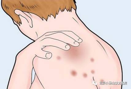 皮肤病的医疗科普口播视频,红蓝光治疗仪能治疗什么病