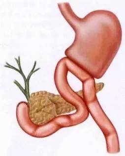 胃镜预处理流程,胃镜内镜手术全流程