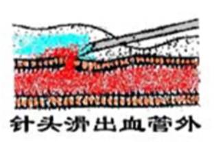 常见静脉输液故障及处理方法,静脉输液故障排除视频