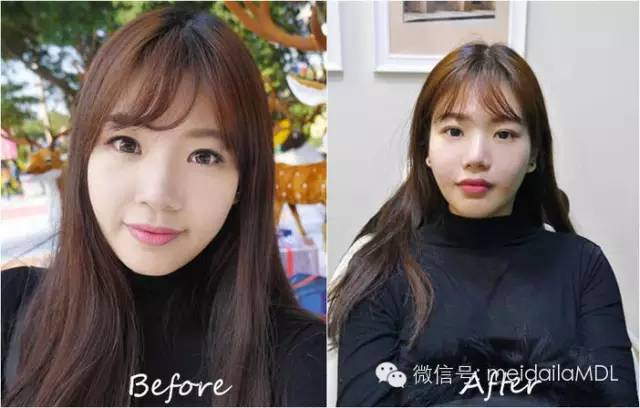 填充法令纹用什么牌子玻尿酸最好,法令纹填充胶原蛋白还是玻尿酸好